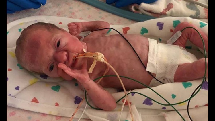 Premature Baby Weighing 2 Pounds Newborn baby