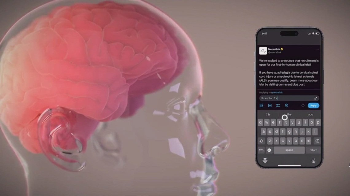 Musk Says First Neuralink Patient Can Control Mouse With Thoughts ...