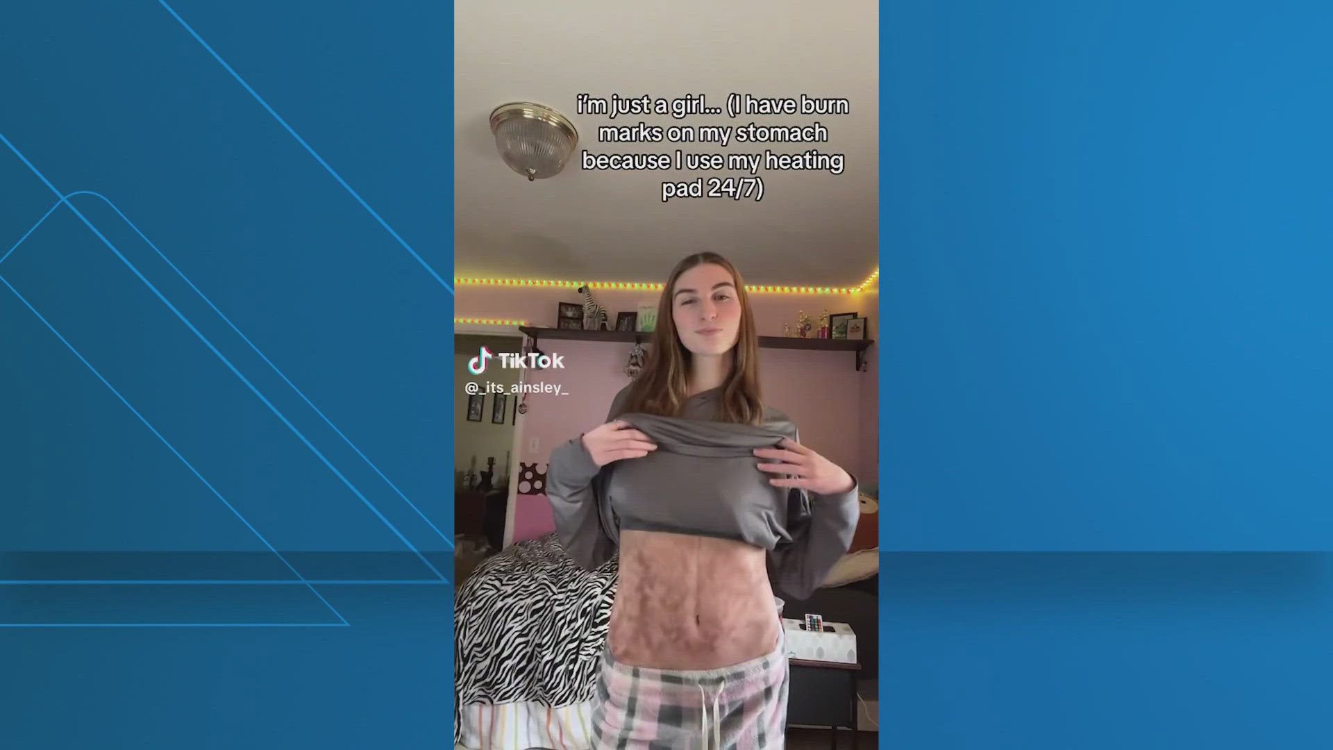 As colder temperatures sweep across the country, dermatologists are warning about a lesser-known condition known as Toasted Skin Syndrome.