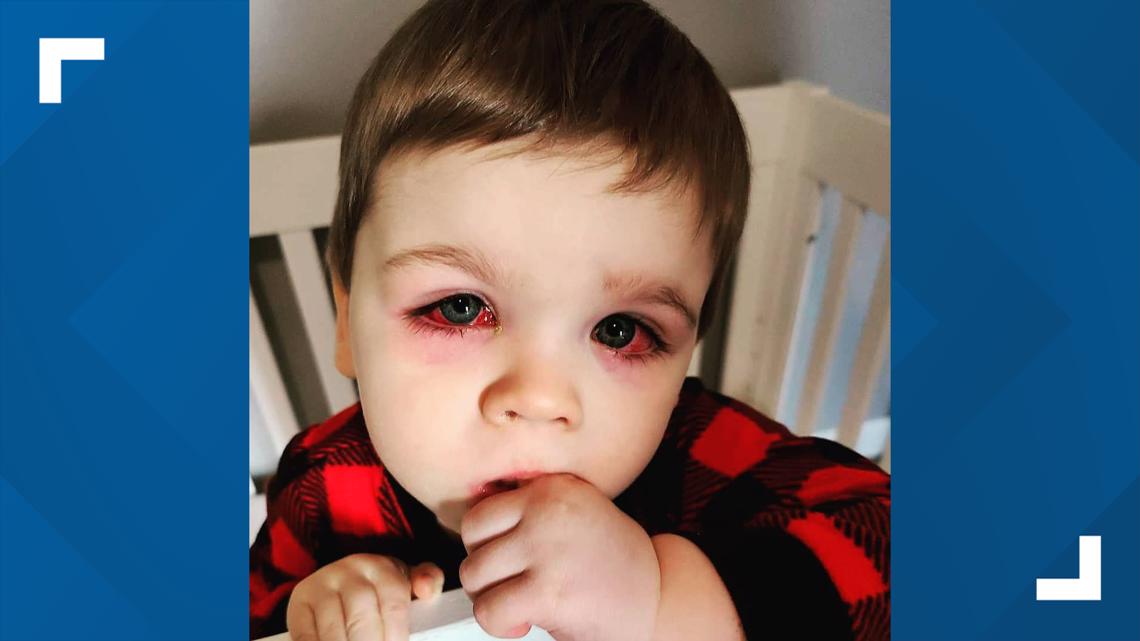 toddler-catches-bacterial-infection-after-squirting-eye-with-water-from