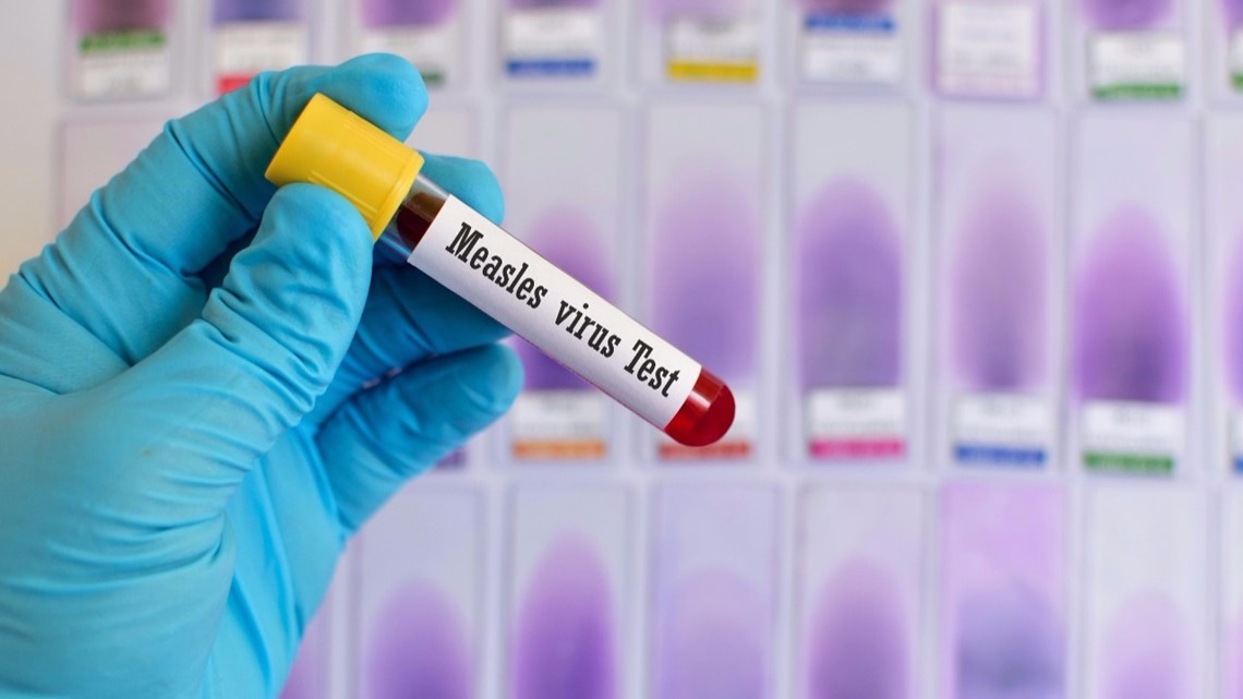 South Carolina reports new measles case in Lowcountry