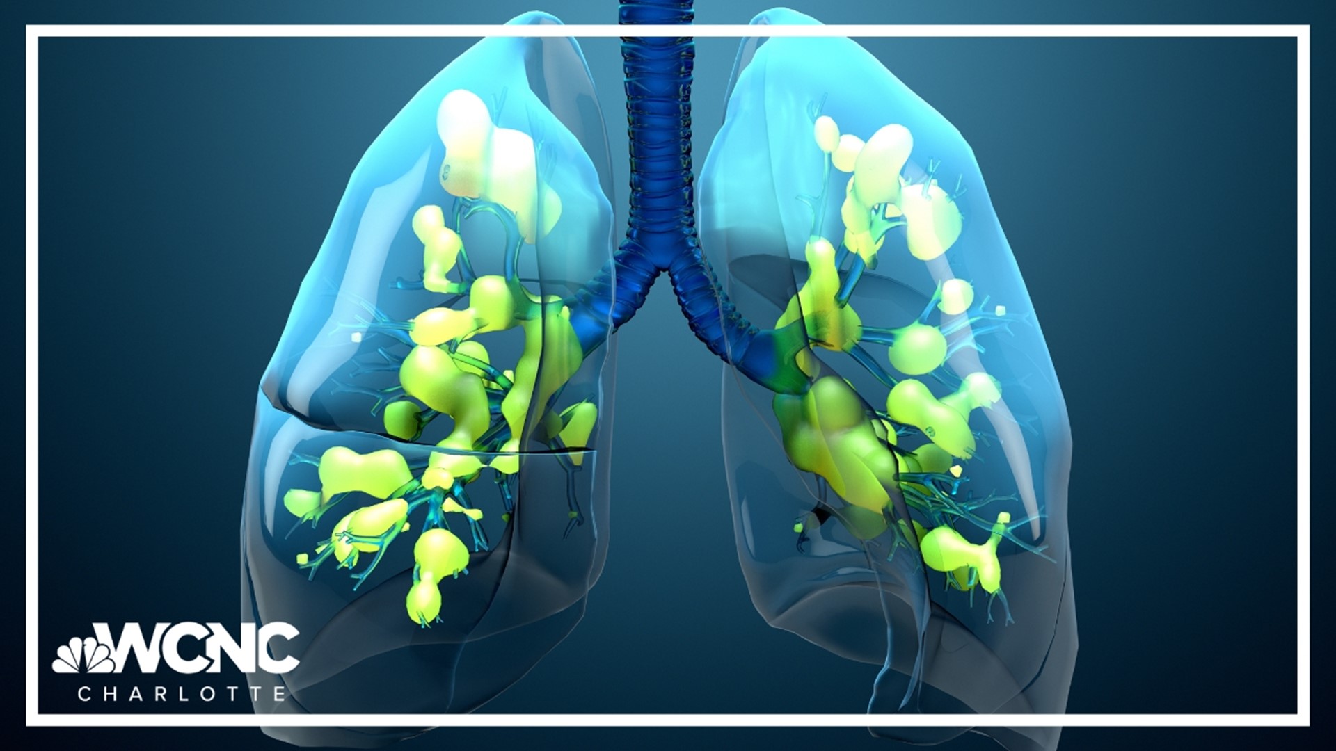 According to the CDC, North Carolina remains in the very high category for flu activity. SC is one of two states with the highest flu activity in the U.S.