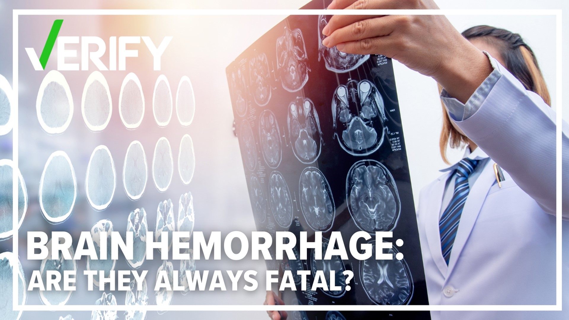 There are several different types of brain hemorrhages. These all depend on where the bleeding happens inside the brain.