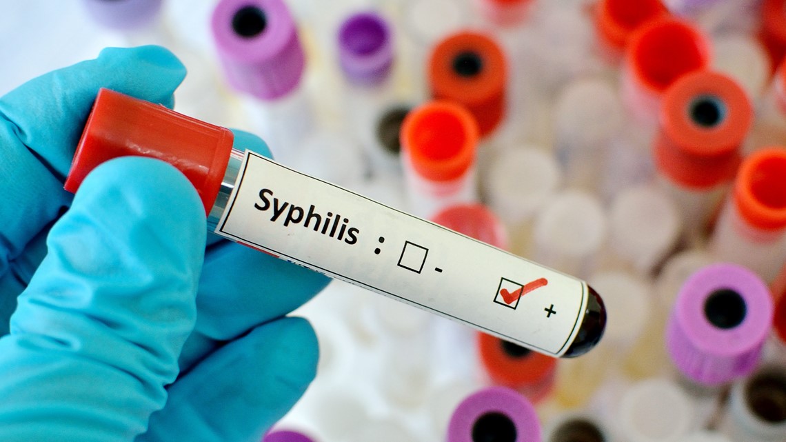 NC Medicaid expands syphilis treatment as cases surge in US | wltx.com