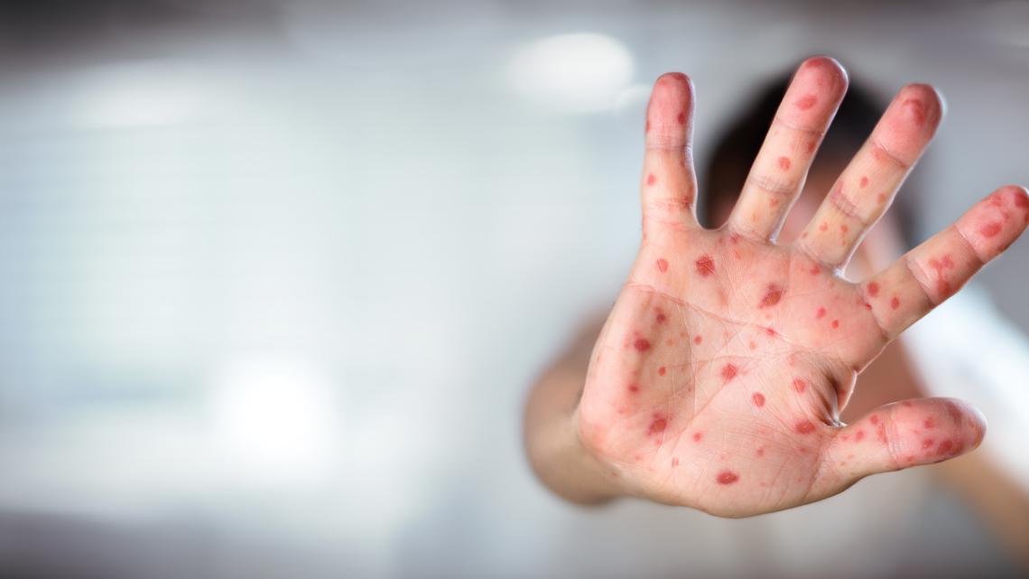 Eight new measles cases confirmed in South Carolina, all linked to Upstate outbreak