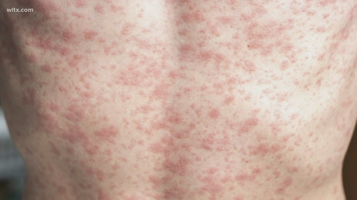 Measles outbreak now affecting over 300 persons in South Carolina