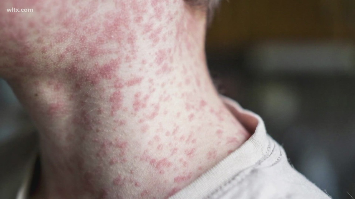 South Carolina confirms two new measles cases linked to Upstate outbreak
