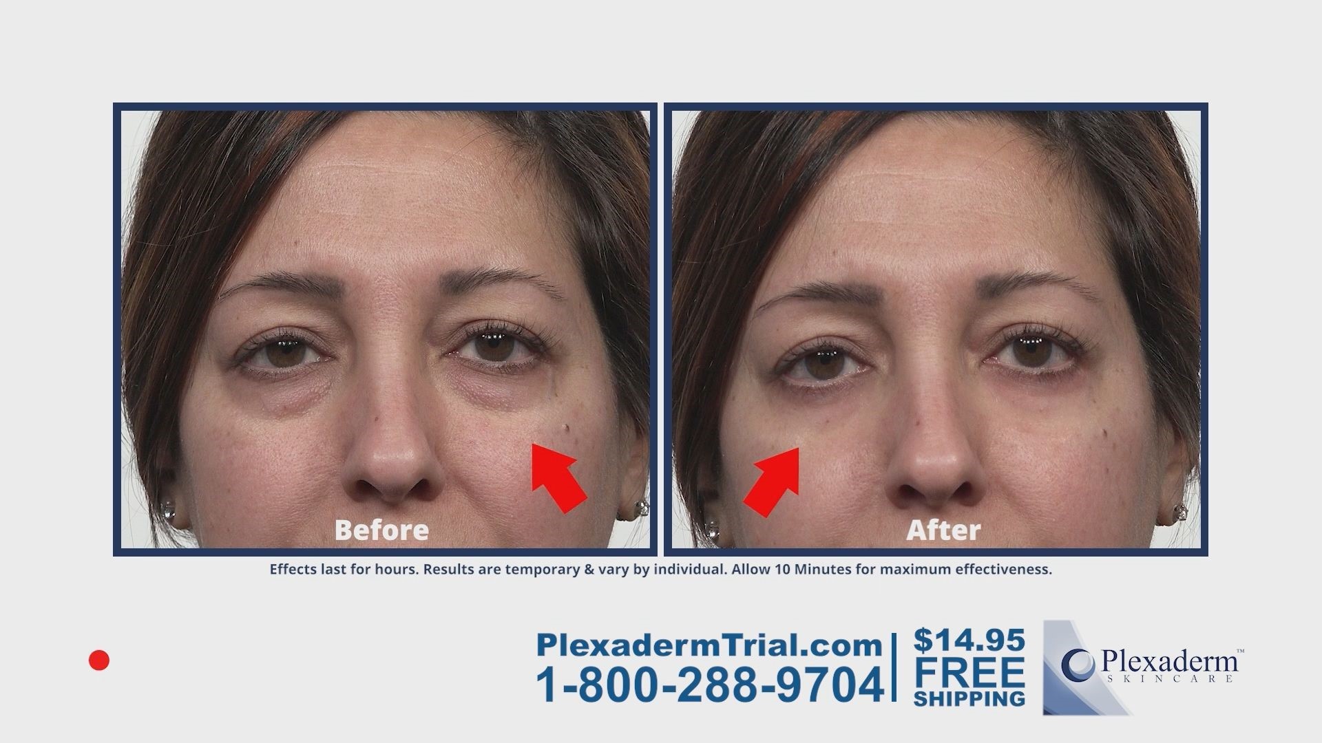 Plexaderm smooths skin surrounding under-eye bags making them shrink from view in minutes.