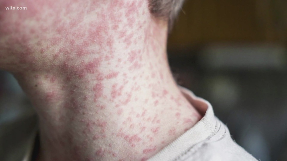 South Carolina confirms measles outbreak in Upstate with five most recent cases