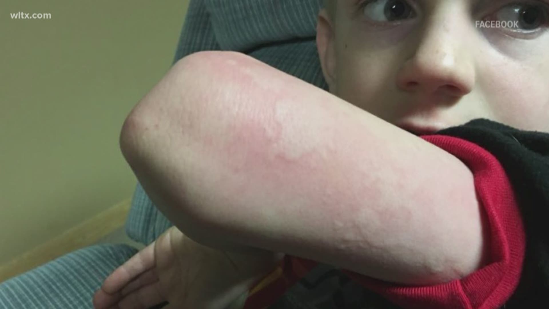 A mom says her son test positive for the flu, but did not have a fever, cough or runny nose. The CDC says symptoms can vary.
