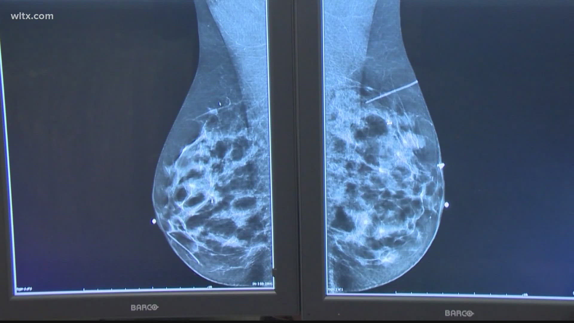 Lexington Medical Center opens high-risk breast cancer