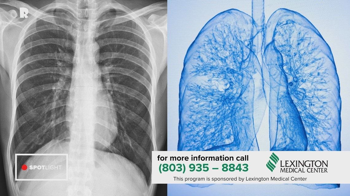 Lexington Medical Center: Lung Cancer Screening