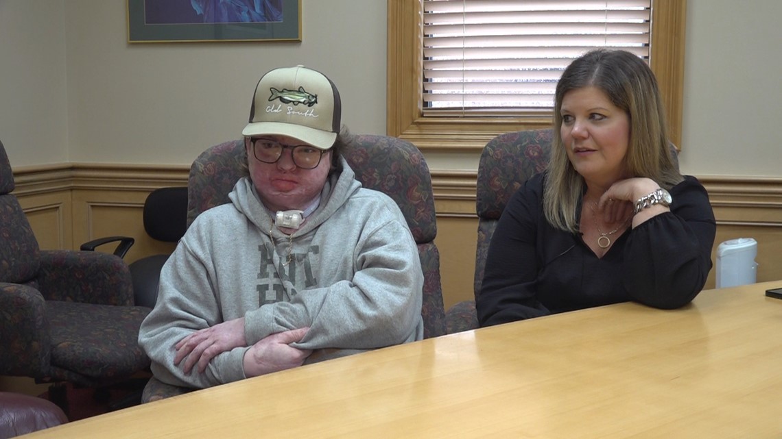 Sumter teen's progress while recovering from burn injuries - Vimarsana News