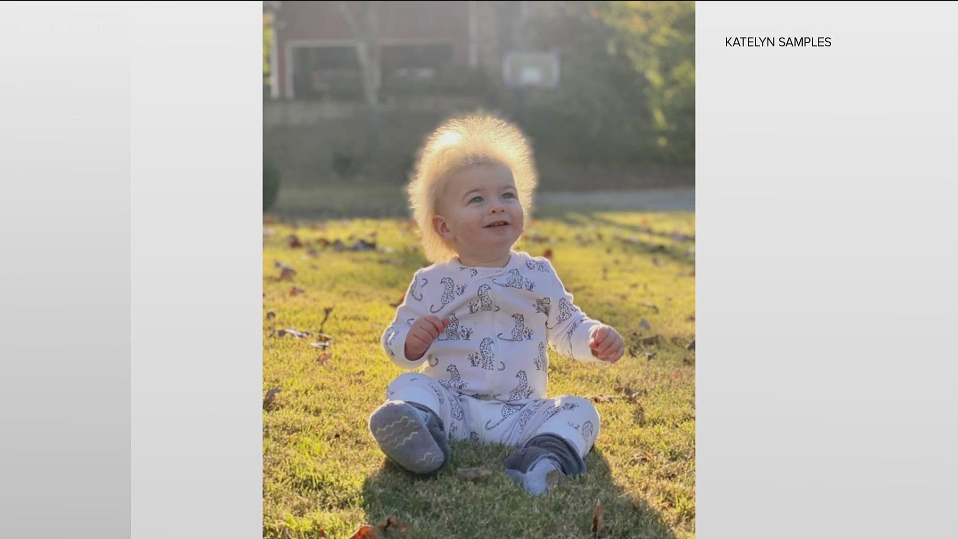 The child is said to have uncombable hair syndrome.